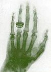 X-ray of the hand of W. Röntgen's wife