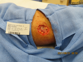 Mohs Surgery - final wound