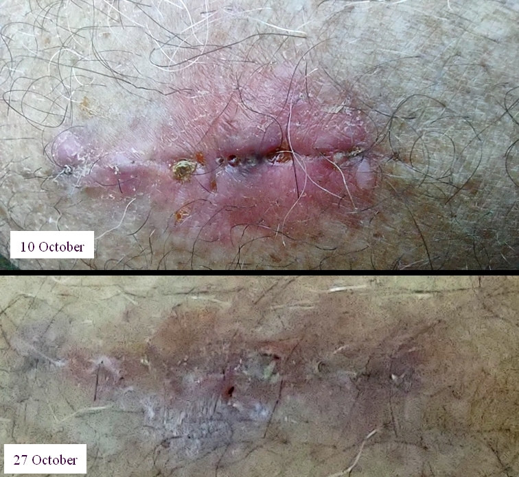 Wound- before and after